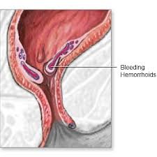 bleeding hemorrhoids